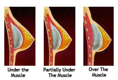 Breast Implants Augmentation and Boob Job in Thailand Surgery