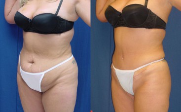 Liposuction-surgery-in-Thailand.jpg