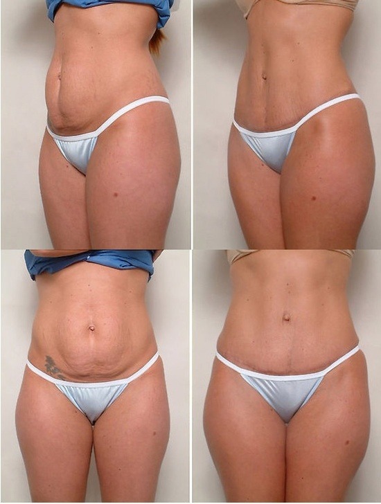 Abdominoplasty after Having Kids - The Lotus Institute