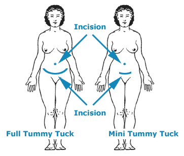 Tummy-tuck-surgery.gif