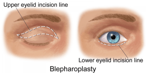 eye lid surgery - face lift