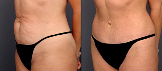 Benefits of Tummy Tuck Thailand with Lotus Medical